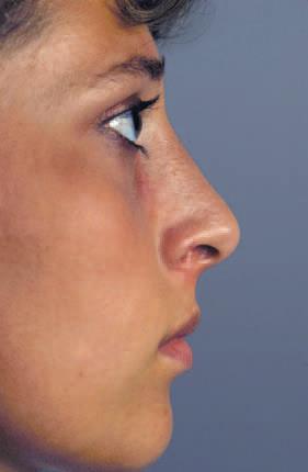 This is essential for a good aesthetic result of the nasal profile (Figures 36a,b).