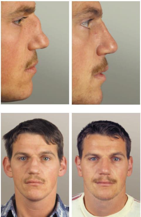 Figure 38 shows the result of this procedure in a patient s nose that has been reconstructed with cartilage taken from his protruding ears.