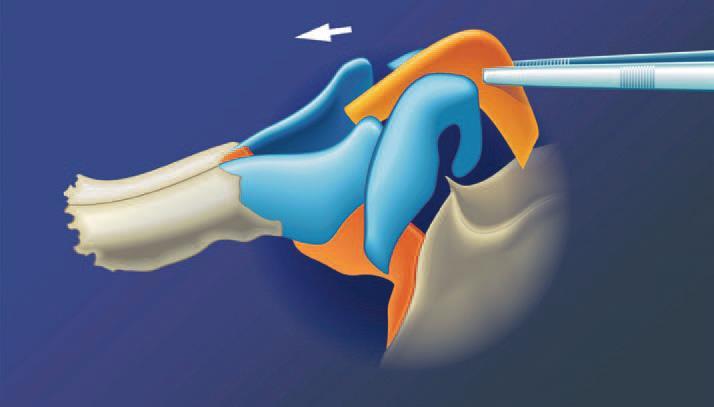 Postoperative view of the same patient after filling the defect with the patient s own cartilage Figure 39a: Schematic reconstruction of anterior cartilaginous septum with