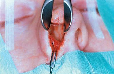 After creating an anterior septal tunnel with a blunt elevator on the concave side, the firm basal attachments of the mucosa to the caudal septum and maxillary crest are dissected with a knife.