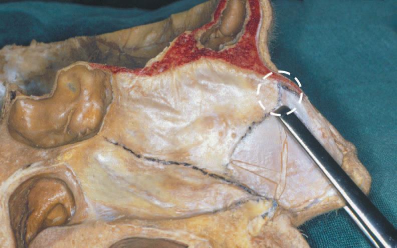 difficult to correct when they belong to the important supporting K-stone area of the septum (Figure 5c). Resection of these malformations bear the risk of destroying this supporting area.
