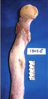 Figure 1 - Healed oblique fracture of right femur with bad alignment and linear deformity with a 15-degree interior angulation in an adult male aged 40-50 years Slika 1.