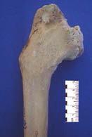 Figure 5 - Healed tibia with bad alignment and linear deformity Slika 5.