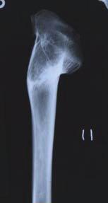 In an article published in British Medical Journal in 1908 [23], Eliot-Smith speaks about the successful treatment of fractured bones in ancient Egyptians with splints.