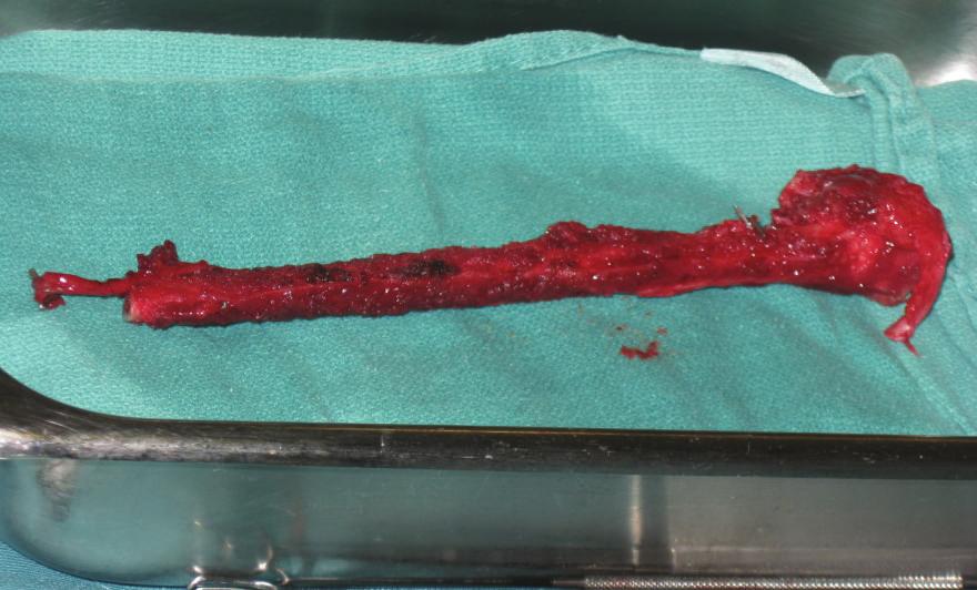 None of the diaphyseal FVFG transfers had defects at the graft site; however, all 4/4 of the epiphyseal transfers had peroneal nerve defects making it the most common