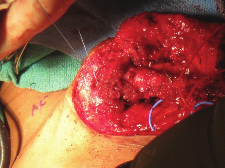 Patients receiving a FVFG without transfer of the proximal fibular epiphysis had an average annual growth of 3.7 mm.
