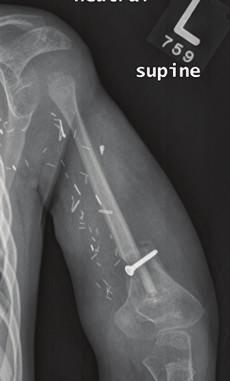 Mean graft hypertrophy index increased by more than 10% in all cases and was similar between epiphyseal and nonepiphyseal FVFG transfers (53.2% and 55.7%, resp.