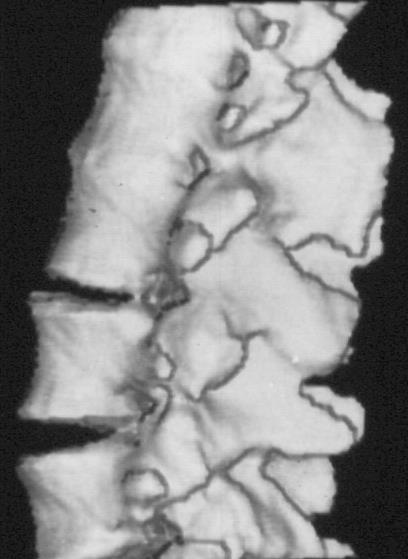 split in the spinal cord Osseous/