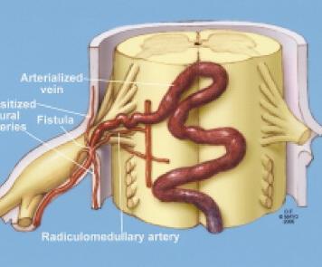 on T2 Causes Vascular AV fistula