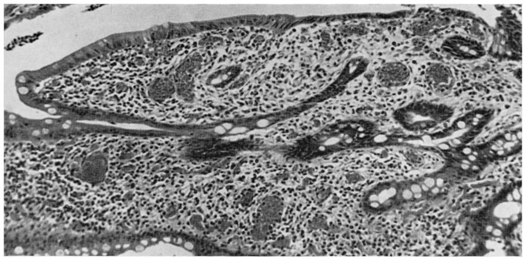 High power magnification showing epithelial r egeneration and distorted glands (H & E, X 100). (see group 2 below).