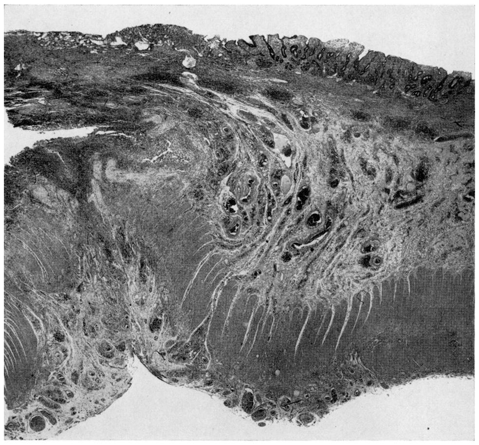 Although the classical histological appearances appear to be well demarcated, we found that it was not always possible to fit cases into one group or the other.