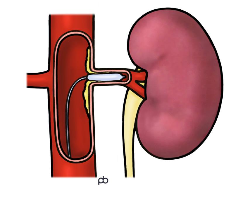 Your doctor has recommended that you have a procedure to treat a narrowing in the artery to your kidney. This is called renal artery angioplasty and stenting.