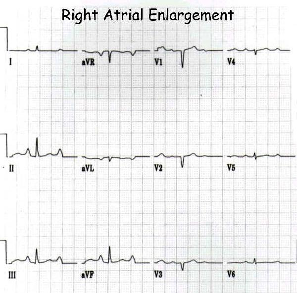 P Wave P Wave in Right Atrial Enlargement Tall, peaked P waves (> 2.5 millimeters high or 0.