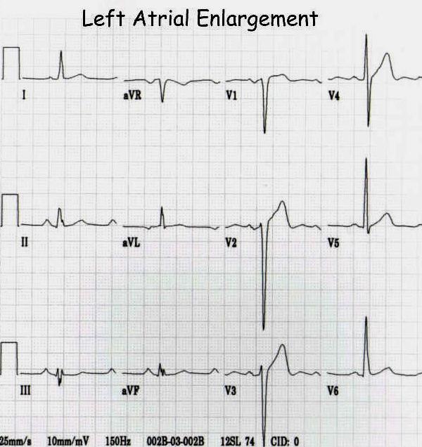 P Wave P Wave in Left Atrial Enlargement P-mitrale: : broad, notched P waves in II and AVF (>( 2.