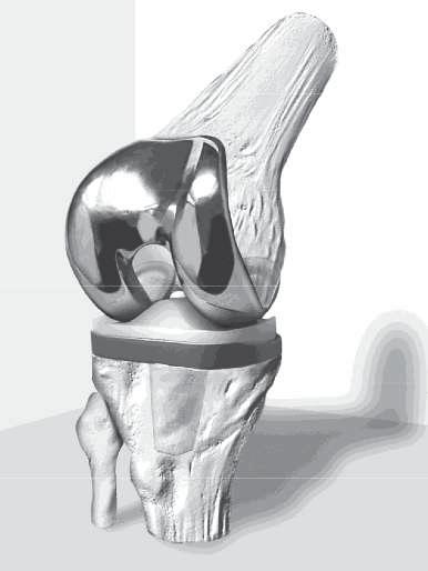 History: The Total Condylar knee represented a significant advance in the design of and instrumentation used for total knee