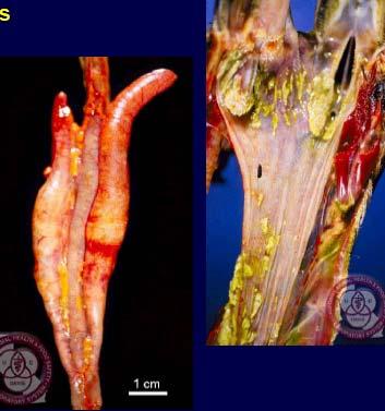 Figure 12.49 Diptheritc oral cavity (right) 3. Petechial hemorrhage may be seen on the myocardium, on liver, pancreas, intestine, lungs, and kidney. 4.