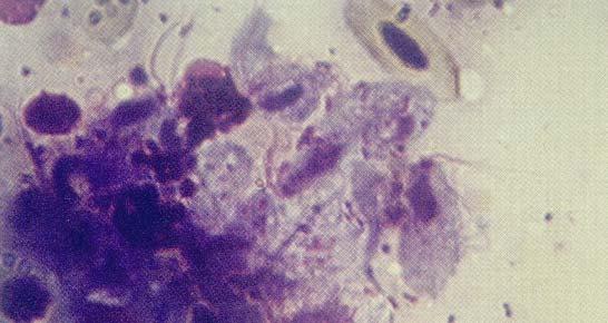 A histopathologist observes trichomonads in the lesions (figure 15.13). 3.