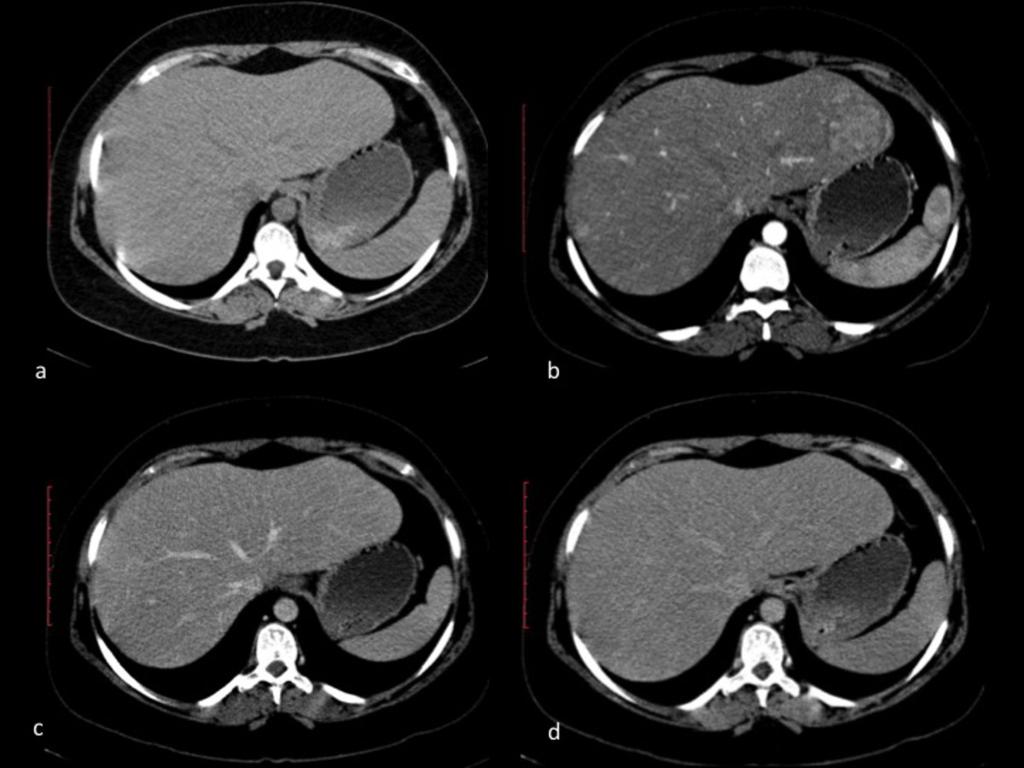 Fig. 2: Axial precontrast and contrast-enhanced CT scan of the abdomen shows hepatic adenomas in a patient with type IA glycogen