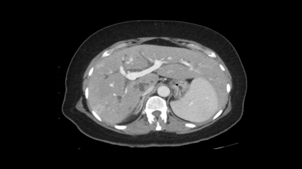 Fig. 8: Intrahepatic hydatid cyst. CT scan shows two well-defined hypoattenuating lesions, both with a coarse area of calcification.