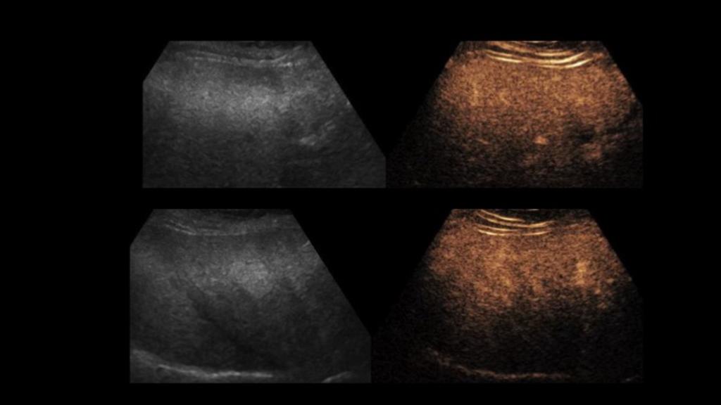 Fig. 12: Focal hepatic steatosis. US scan of the liver shows a multiple hyperechoic focus a finding consistent with focal fat.