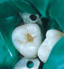 If the caries does not extend beyond the level of the enamel dentine junction fissure sealant only may