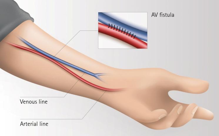 WHAT IS AN ARTERIO-VENOUS FISTULA? A fistula is the most common type of dialysis access. Creating a fistula involves a small operation on the wrist or arm to join together a vein and an artery.