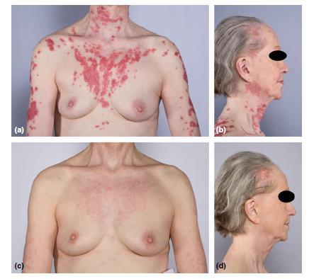 LENALIDOMIDE FOR TREATMENT OF CUTANEOUS LUPUS 16 patients with DLE and SCLE 1 Median R-CLASI activity decreased from 23 to 4 (p<0.