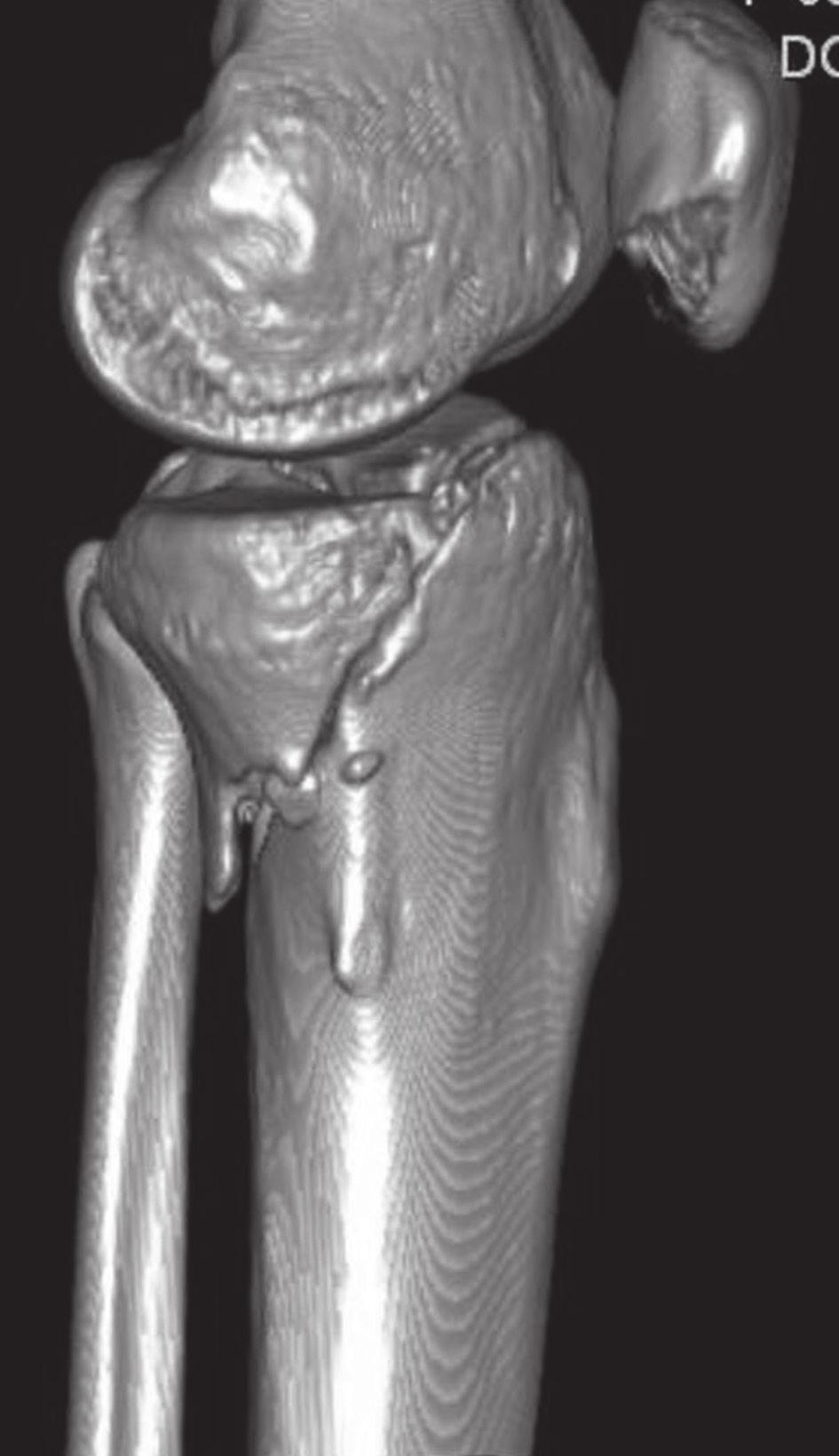 posteromedial tibial plateau fracture 262 c d c,d. Preoperative 3D CT reconstruction images of lateral and posterior views.