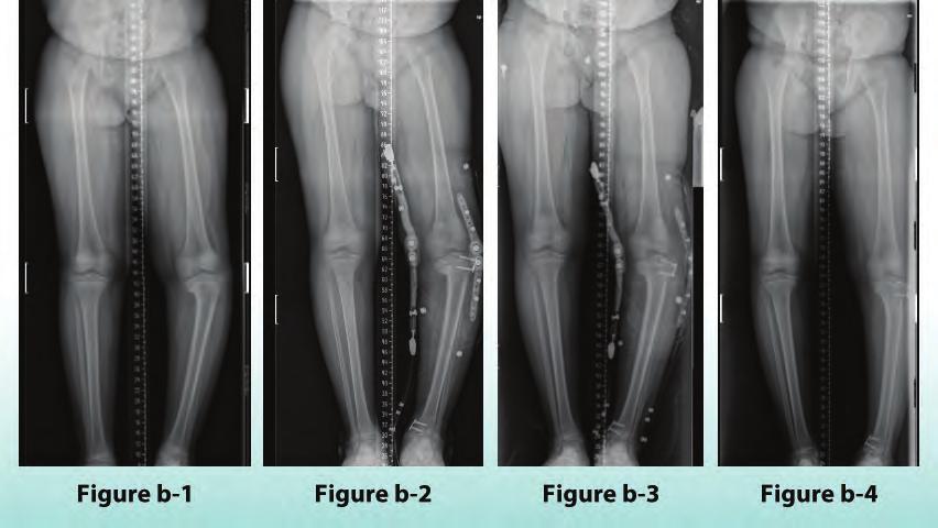 Conclusion At this preliminary stage in the patient s treatment, the use of the vokafo has shown favorable results in obtaining ongoing realignment of the tibia even though the patient had risk
