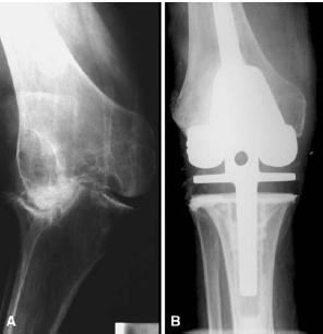 fracture often associated with high dose steroid use LESS DIFFICULTY BALANCING Long term Longstanding OA &