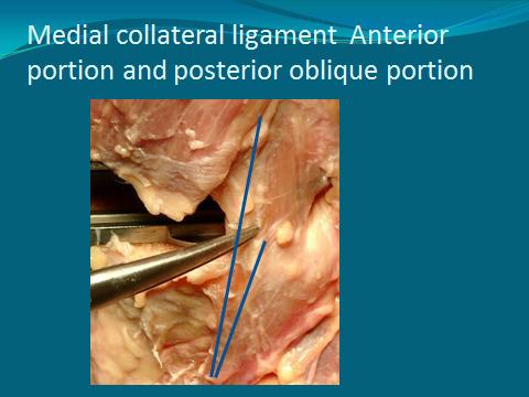 07/02/14 Ligament Balancing Still tight- pie crust proximal MCL