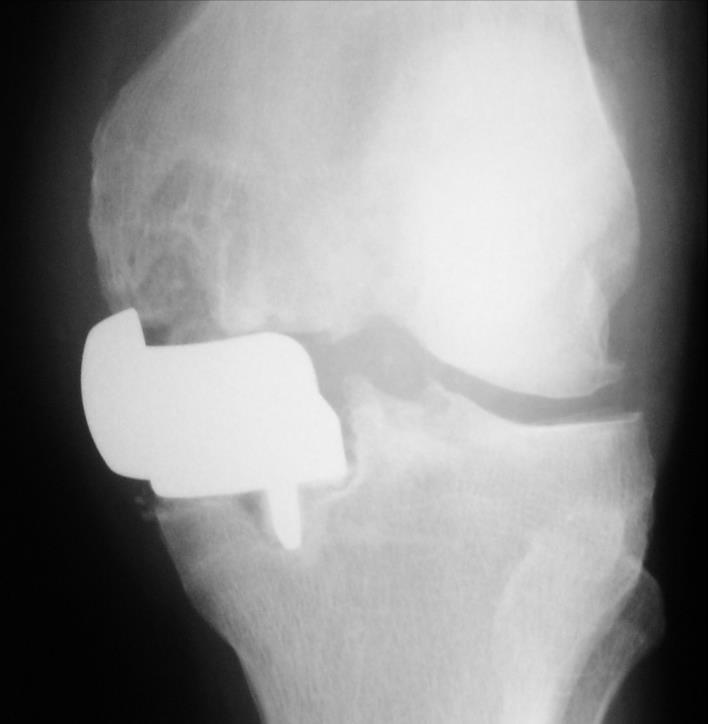 FEMORAL LOOSENING Cause Inaccurate cuts & cementing Prevention Surgical