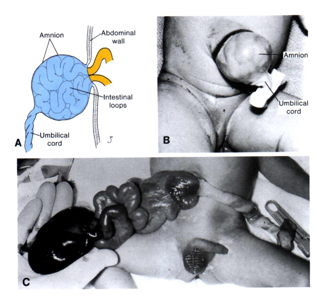 Deficiency of anterior abdominal wall Congenital defect A & B