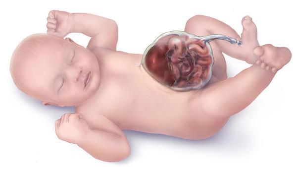 Abnormalities: 1-Omphalocele: is the failure of the intestines to return to the abdominal cavity, the infant will be born with outside bulging of the intestine.