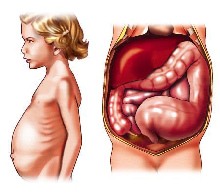 digestive tract, It may be connected to the umbilicus by a fibrous cord or an omphaloenteric fistula.