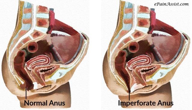 5-Imperforated anus: is a common problem in which the proctoduem will not open completely and this can be corrected easily by a simple syrgery.