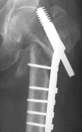 Challenge: Postoperative complications 4% 16% complication rates after proximal femur fractures 2,6 7,19 The solution: risk of implant failure and reoperation 4 5,8,13 15,17,22,24 26,28 More than 4x