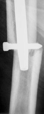 risk of implant failure and reoperation Challenge: Varus collapse Varus collapse of the femoral head and neck Lag screw cutout Revision surgery The solution: Significantly less varus collapse 6,16,21