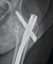 5x less varus collapse when compared to the single screw device 21 In a retrospective clinical study comparing and Gamma3 Challenge: Peri-implant fractures The solution: Low risk of secondary femoral