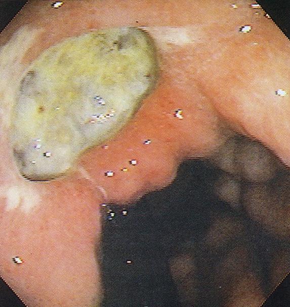 Gastric or duodenal ulcer Action: If H.