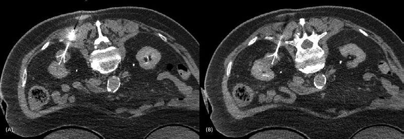 Patients with renal insufficiency can be challenging as contrast is usually avoided. Therefore, one must rely on cortical changes in the non-contrast phase to delineate the lesion, Figure 1.