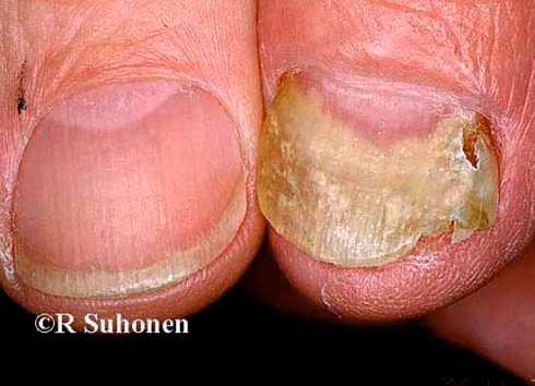 other dermatophytes Griseofulvin for infections involving the scalp and