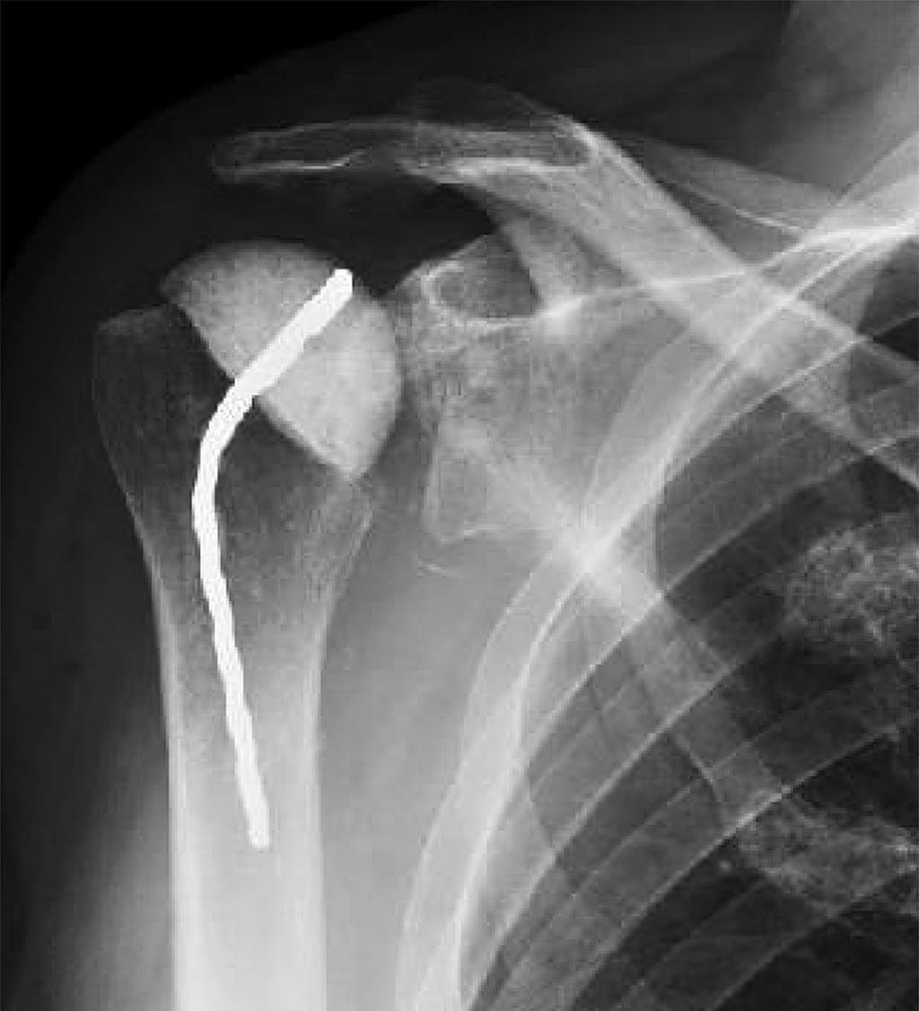 As opposed to prosthetic infections of the hip and knee, treatment algorithms are not well defined and shoulder surgery textbooks contain little information concerning the therapy of infected