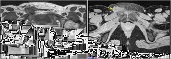 Figure 3 Axial T1 and Fat-supressed T1-weighted images Figure 4 T1-weighted images after intravenous contrast