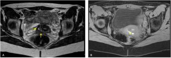 : Franscico Gentil, Portugal Figure 5 Deep pelvic endometriosis :T2-weighted images (A) showed a hypointense spiculated