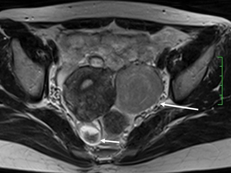 () Transverse T1-weighted image shows a homogeneous hyperintense cyst (long arrow) in the