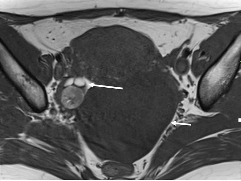 () Transverse T1 weighted image shows several hyperintense lesions (arrows) in the pouch of