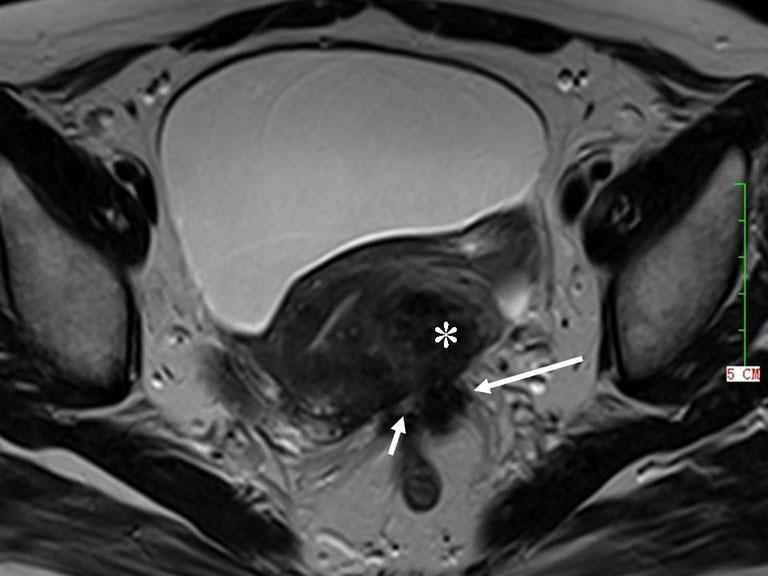 190 Tang et al. Deep infiltrating endometriosis MRI Figure 6 53-year-old woman with DIE.