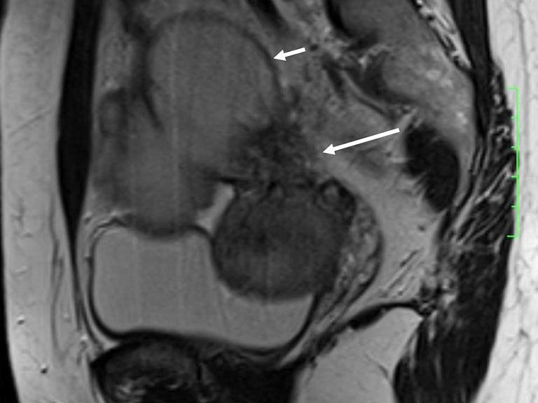Figure 7 37-year-old woman with DIE. Sagittal T2-weighted image shows an irregular nodule (long arrow) with stellate margins in the right uterosacral ligament and an endometriotic cyst (short arrow).