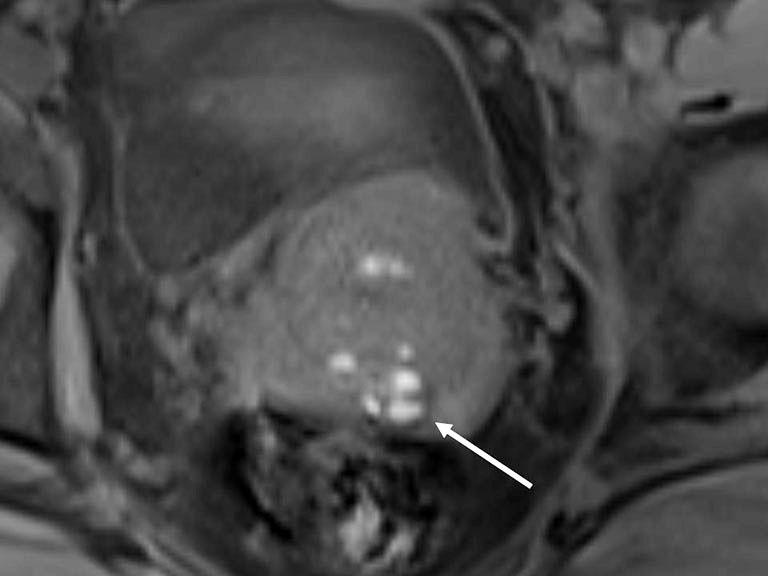4%), and other extraperitoneal pelvic sites (15). t MR imaging, the diagnosis of DIE can be made by the joint presence of signal intensity abnormalities and morphologic abnormalities (8).